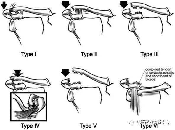 肩锁关节脱位:"3个步骤 9种治疗方法"