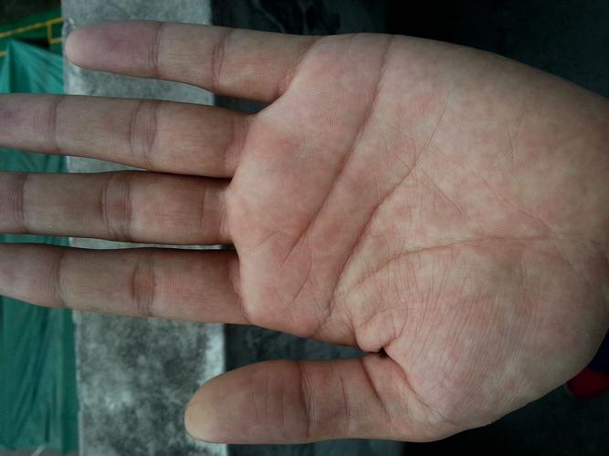 请大家看看一下我这手掌颜色健康吗 谢谢 只有这点分了.