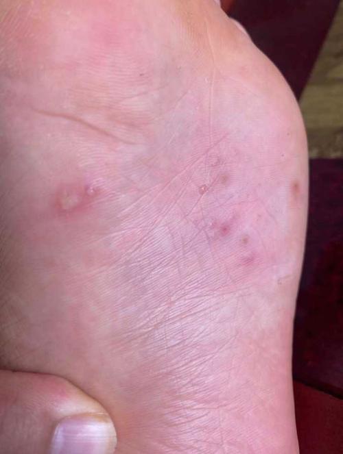 脚底脚心起了好多小水泡一波下去一波又起只是一只脚另一只脚一个都没