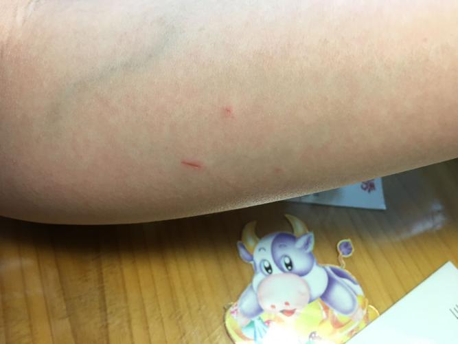 被小野猫抓伤,是否需要马上注射狂犬疫苗.急