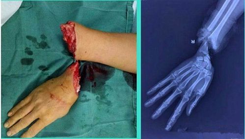 术中我们仅用了最简单的材料,仅几枚克氏针就完成了这个复杂的手术.