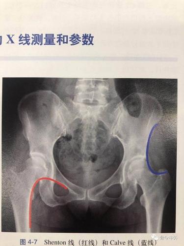 骨科基础丨髋关节的x线测量和参数