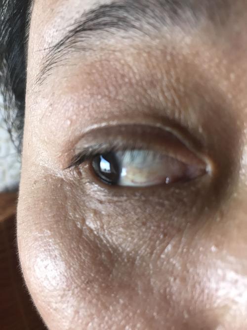 最近眼睛的眼白上有黄斑,没有什么感觉也不影响视线,这是什么情况,有