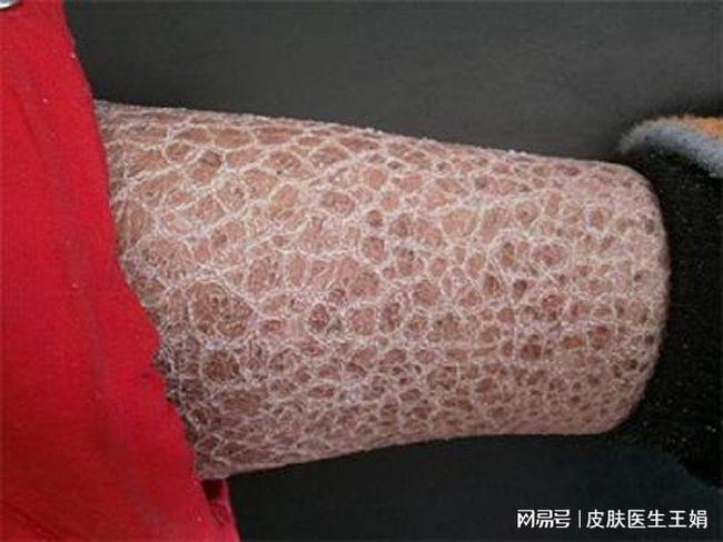哪些情况说明是鱼鳞病|鳞屑|红斑|皮肤粗糙|皮肤病