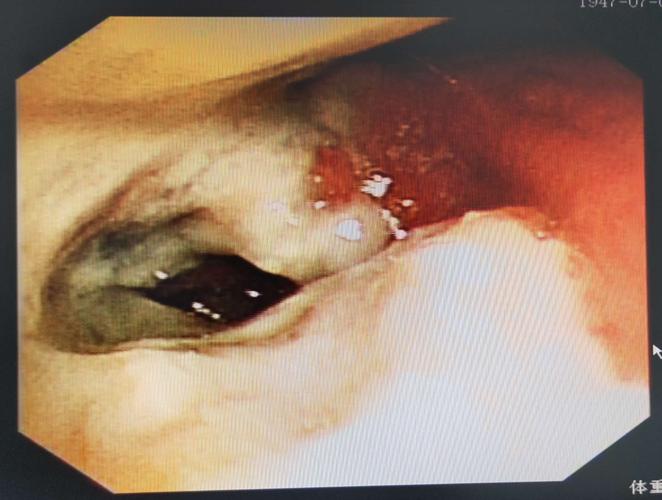 肺结核的气管镜下表现