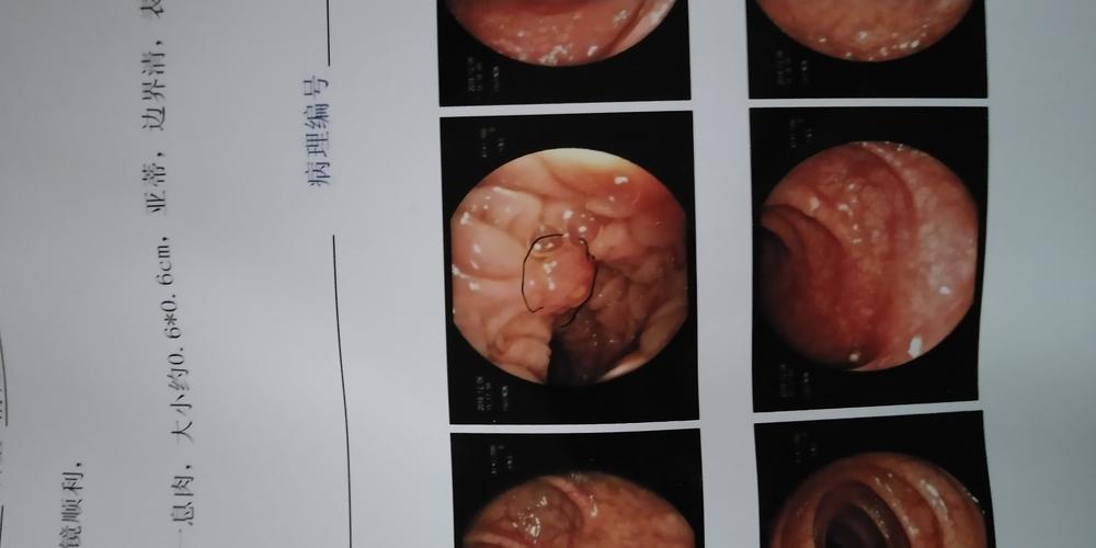 请帮忙看下这个肠息肉是恶性的几率多高