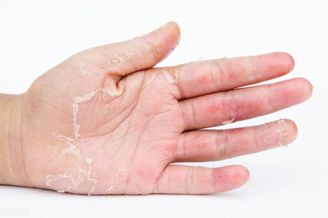 听本文分析|真菌|手癣_网易订阅