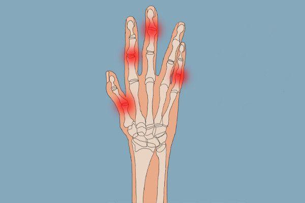 一位程序员手疼7年以为是键盘手却查出骨肿瘤是癌吗