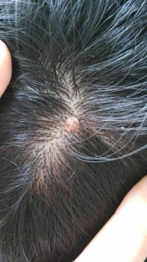 头皮上长个这个是什么东西,一开始以为是豆豆,用手扣完变大了,肉疙瘩