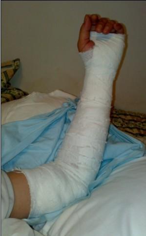 石膏托配合绷带包扎