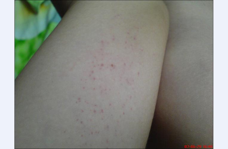 手臂上多了许多像针眼大小的小红点,不痛不痒没感觉