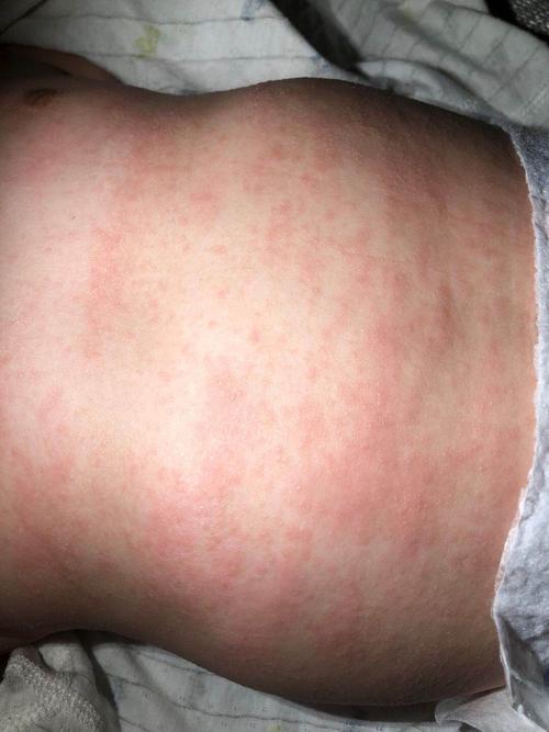 5个月大宝宝身上长满了红点,是什么?_母婴_育儿_母婴