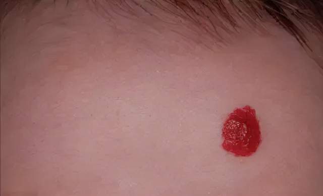 被忽视的血管瘤,宝宝有这种"红斑"要警惕