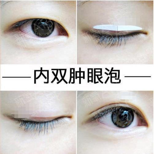 眼睛是肿眼泡可以单独只做眼部吸脂吗能改善肿眼泡吗