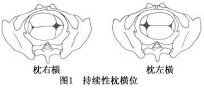 持续性枕横位难产