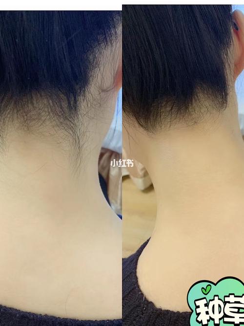 第一次勇敢尝试后颈脱毛(后发际线脱毛)