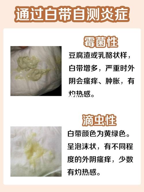 像白带异样,量多,颜色重,或者私处有味,瘙痒,这些都算是妇科炎症的