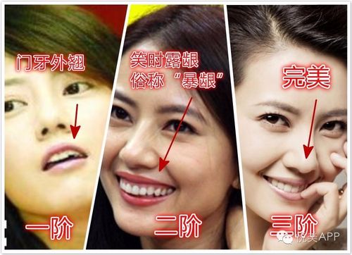 你是地包天都以为明星好当原来偷偷做了截骨术