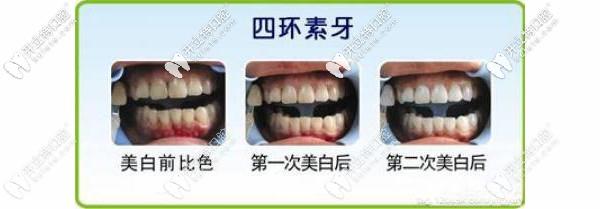 做四环素牙牙齿漂白多少钱做出来不知道效果好不好