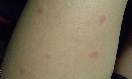 为什么我的大腿上有红斑