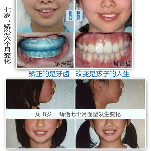 儿童牙套牙齿矫正器夜间隐形纠正地包天反颌龅牙不齐