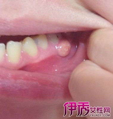 【图】牙龈发炎肿痛的原因 该症状有哪些症状呢