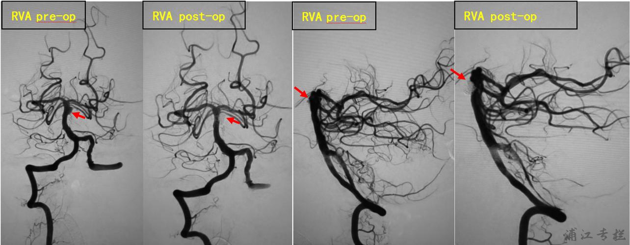 双侧椎动脉造影均显示夹层动脉瘤栓塞完全,基底动脉管腔通畅.