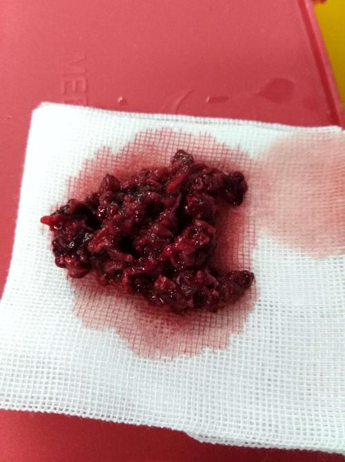 取出来的是红色硬化血栓,为亚急性至慢性的血栓.