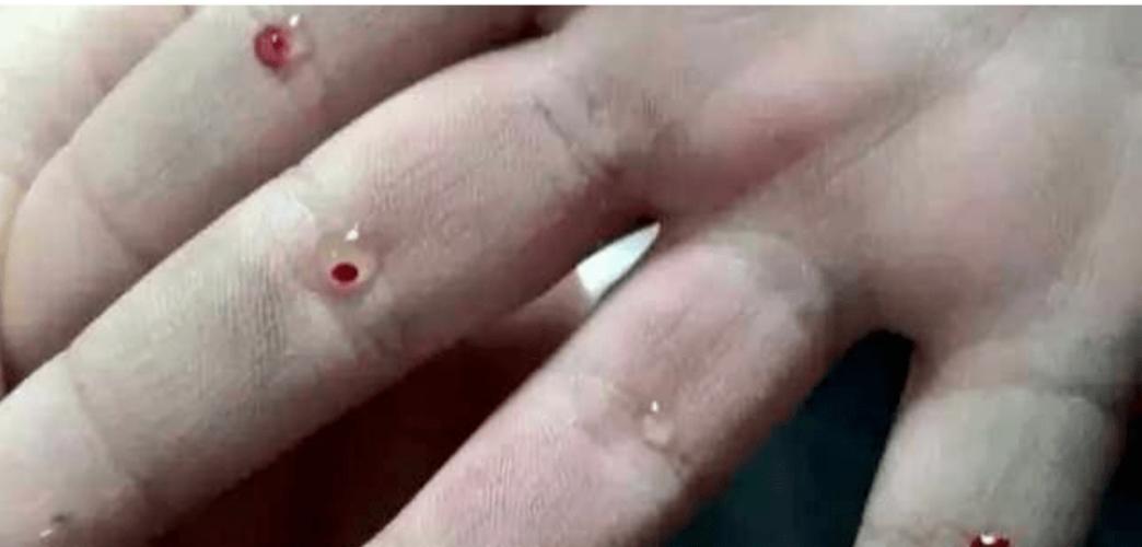小儿疳积不用愁,指间四缝有奇功