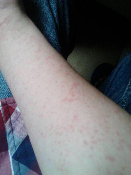 病毒性皮疹的介绍