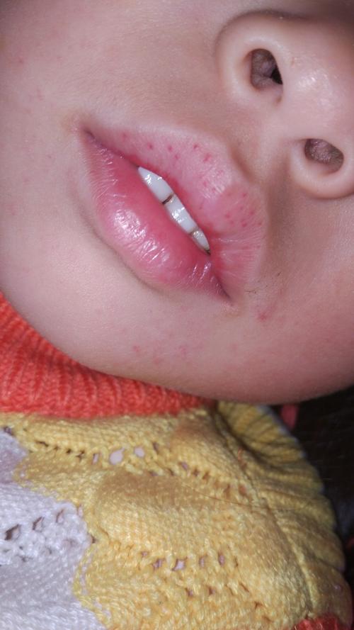 5岁孩子,发热,嘴唇布满小红点,这是啥病?