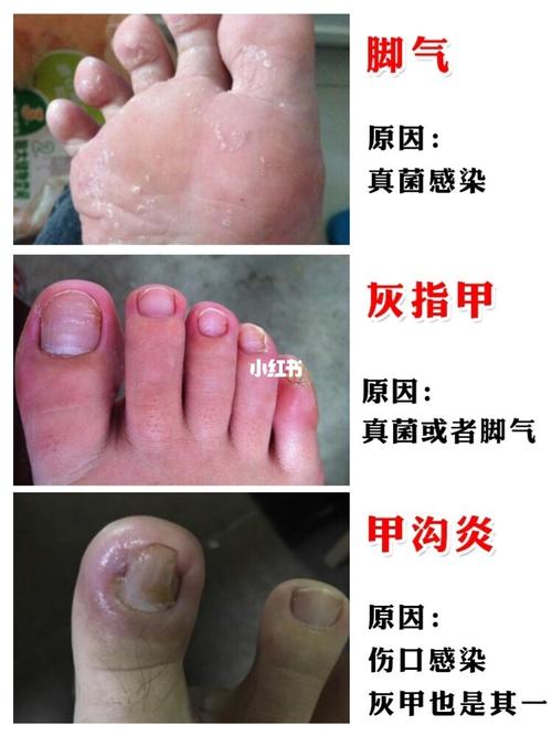 我的灰指甲,甲沟炎终于治好了_灰指甲_甲沟炎_脚气_脚部护理_医疗健康