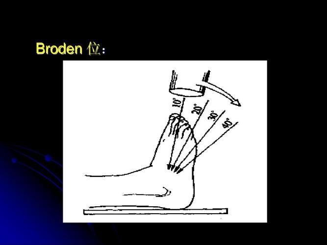 跟骨骨折(讲稿)ppt