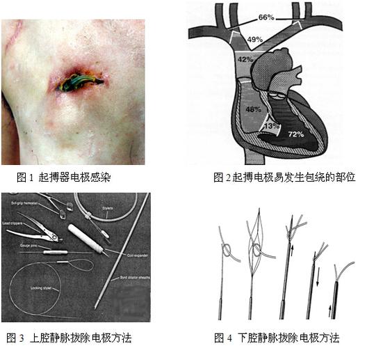 学术文章 >> 正文      随着心脏起搏技术在临床的广泛应用,起搏器术