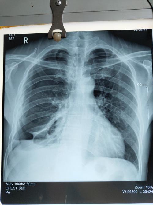 外科治疗多发肋骨骨折合并血气胸一例(李爱雄,赵毅团队)