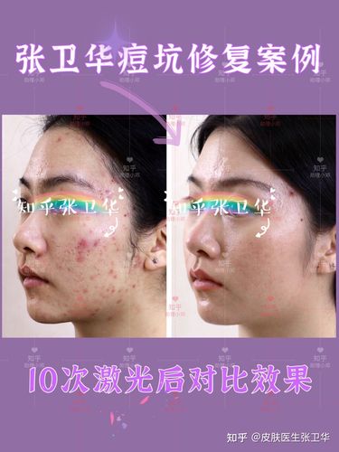 满脸痘坑的女孩,通过点阵激光治疗得偿所愿了