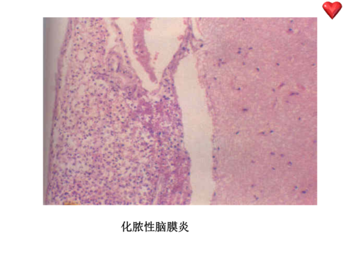 化脓性脑膜炎 脾脓肿(左)和脑脓肿(右) 心肌