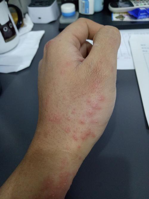 大漆过敏,奇痒难忍