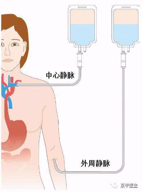 肠外营养是通过静脉途径为患者提供营养素,包括中心静脉和外周静脉