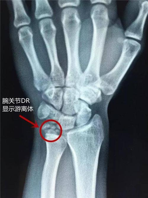 小伙手腕疼10年,找不到原因!0.5cm微创小伤口,一次解决烦恼!