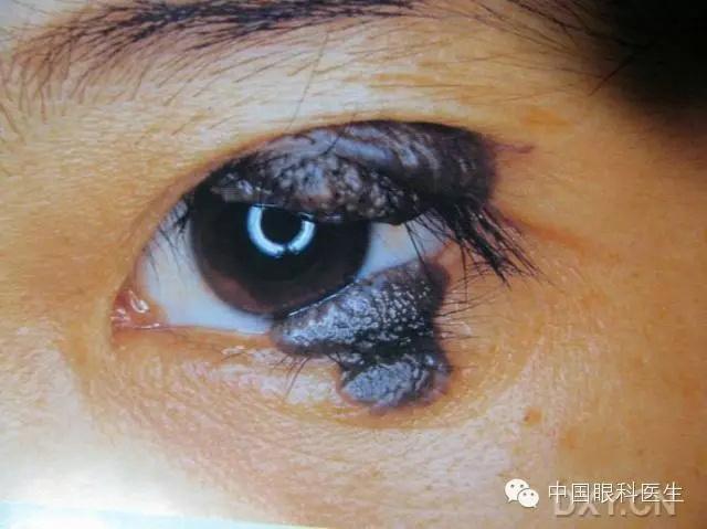 多种眼睑常见疾病图片(十分难得的病例图集,必须收藏!