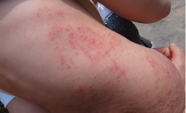 疥疮怎样可以根治