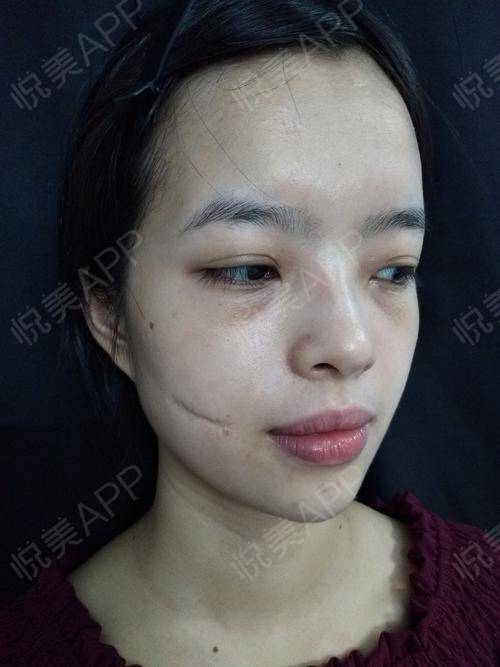 前年一场意外在脸上留下的一块无法遮盖的凹陷疤痕,因