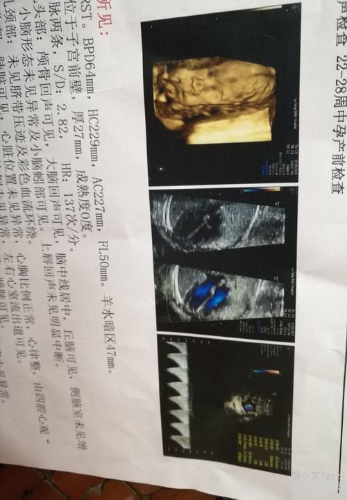 孕期26周做四维彩超看得出是男宝宝还是