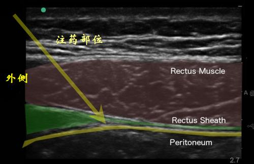 超声引导腹直肌鞘阻滞
