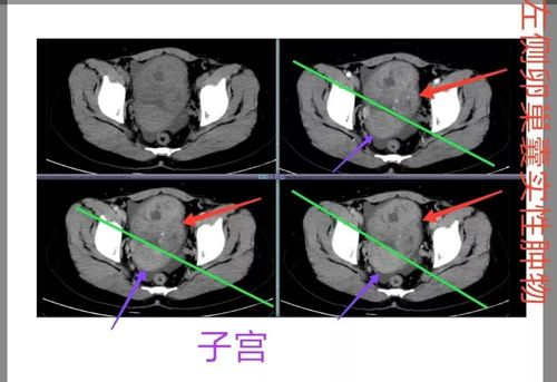 ct重点看看双侧附件病变. 卵巢囊实性肿物,中度强化.