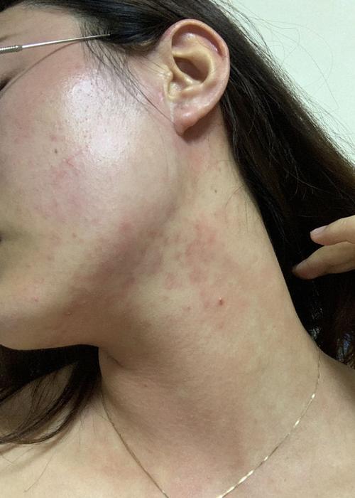 这个是不是酒精过敏