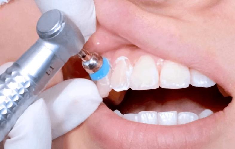 等牙体牙周疾病 //抛光// 为了使牙齿更光亮 洗牙后还要进行精细抛光