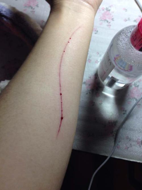 手臂(女)被钉子划伤,如何尽快消除痕迹?