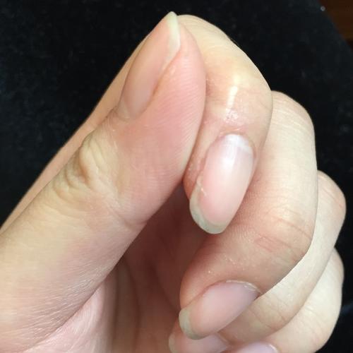 手指甲两边经常裂开